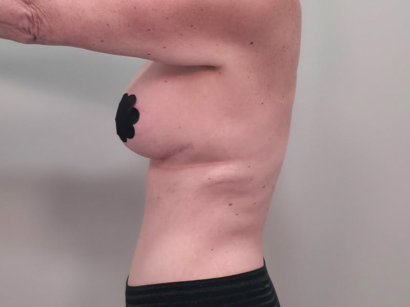Breast Augmentation-Mastopexy Before & After Gallery - Patient 366909 - Image 12