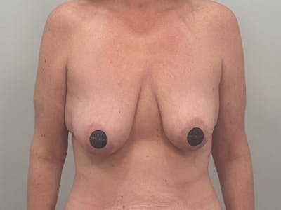 Breast Augmentation-Mastopexy Before & After Gallery - Patient 366909 - Image 1