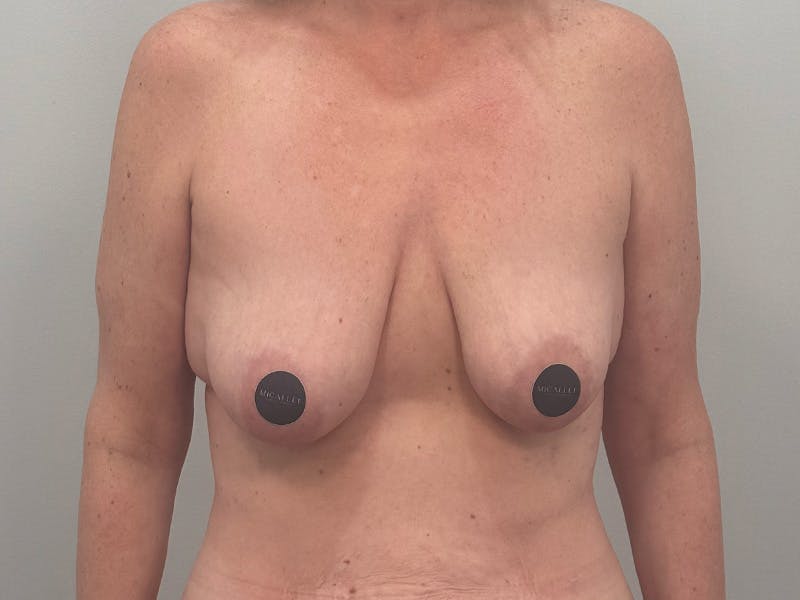 Breast Augmentation-Mastopexy Before & After Gallery - Patient 366909 - Image 1
