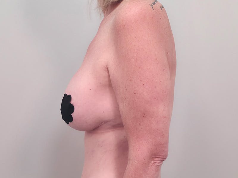 Breast Augmentation-Mastopexy Before & After Gallery - Patient 366909 - Image 10