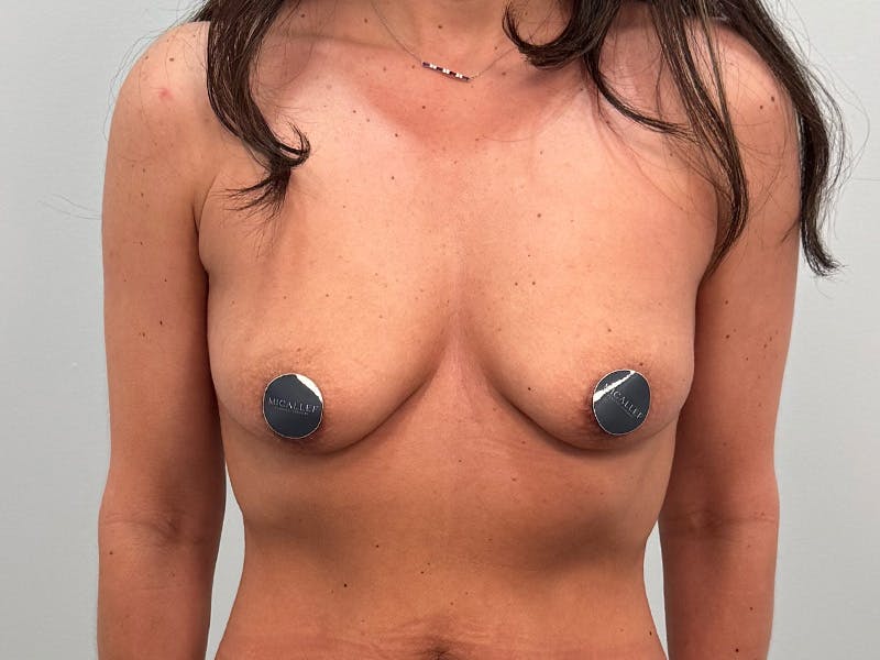 Breast Augmentation-Mastopexy Before & After Gallery - Patient 162330 - Image 1