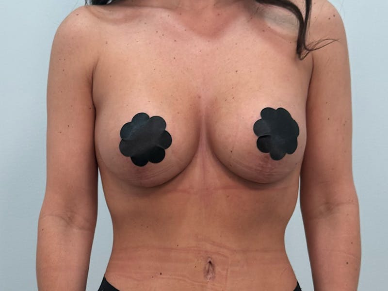 Breast Augmentation-Mastopexy Before & After Gallery - Patient 162330 - Image 2
