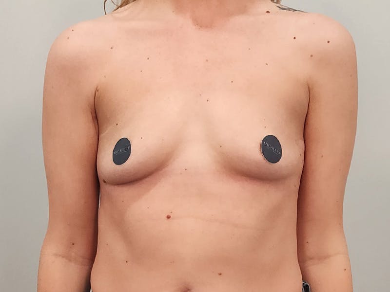 Breast Augmentation Before & After Gallery - Patient 413455 - Image 1