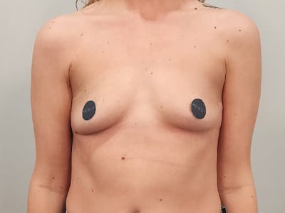 Breast Augmentation Before & After Gallery - Patient 413455 - Image 1