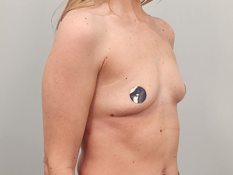 Breast Augmentation Before & After Gallery - Patient 413455 - Image 3
