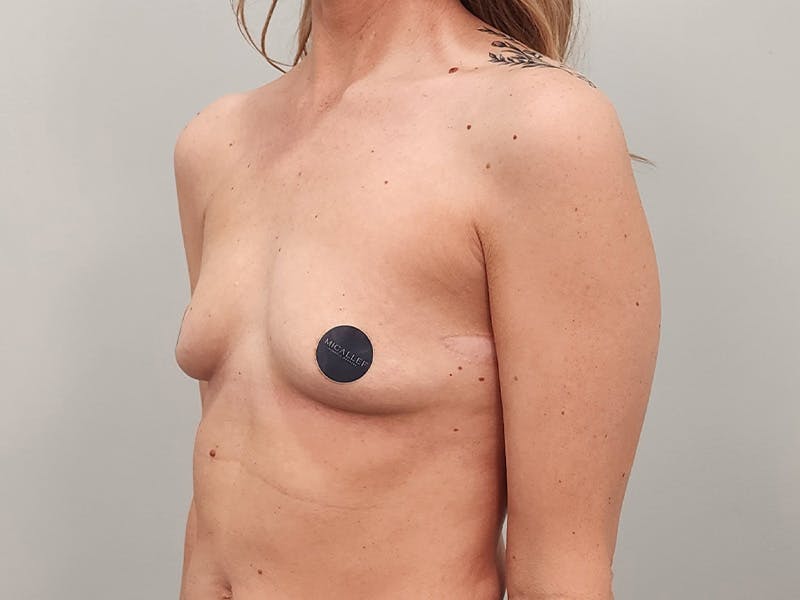 Breast Augmentation Before & After Gallery - Patient 413455 - Image 7