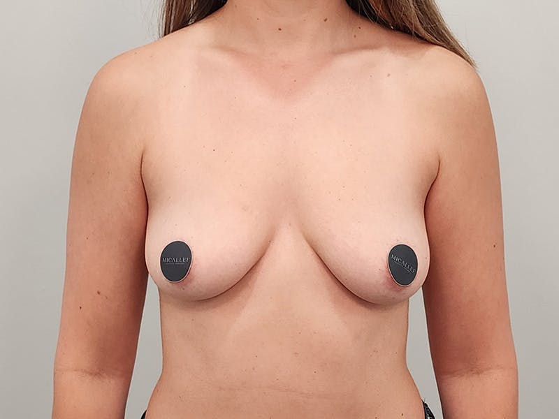 Breast Augmentation Before & After Gallery - Patient 803461 - Image 1