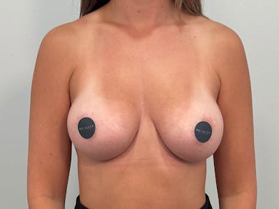 Breast Augmentation Before & After Gallery - Patient 803461 - Image 2