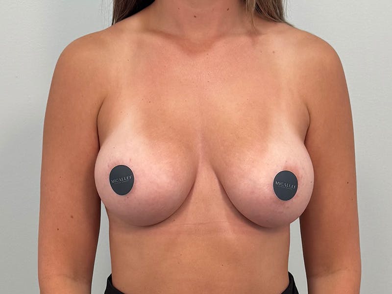 Breast Augmentation Before & After Gallery - Patient 803461 - Image 2