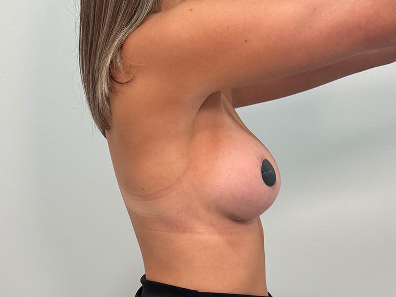 Breast Augmentation Before & After Gallery - Patient 803461 - Image 8
