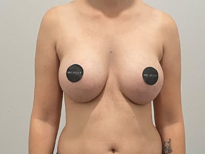Breast Augmentation Before & After Gallery - Patient 380297 - Image 2