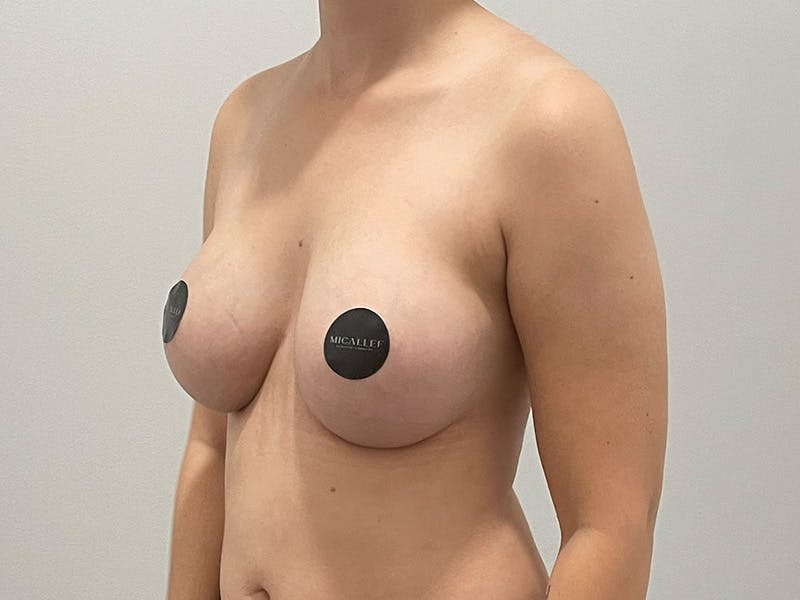 Breast Augmentation Before & After Gallery - Patient 380297 - Image 8