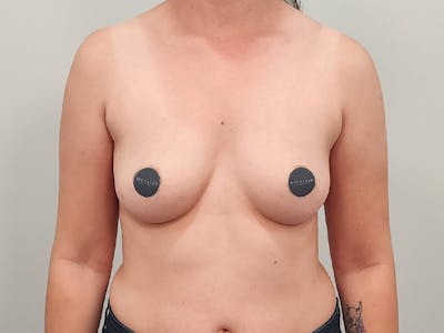 Breast Augmentation Before & After Gallery - Patient 380297 - Image 1