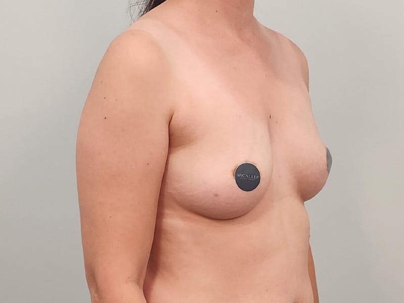 Breast Augmentation Before & After Gallery - Patient 380297 - Image 3