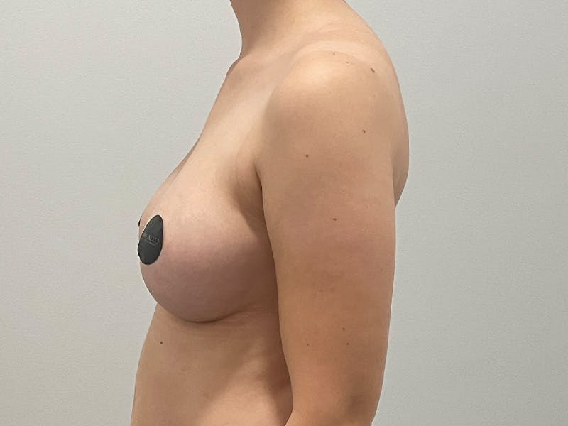 Breast Augmentation Before & After Gallery - Patient 380297 - Image 10