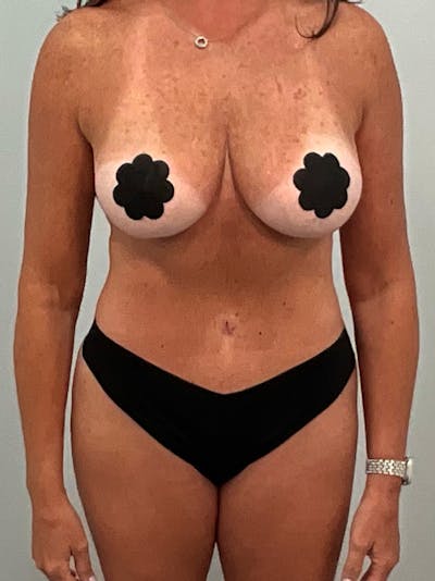 Tummy Tuck Before & After Gallery - Patient 234056 - Image 2