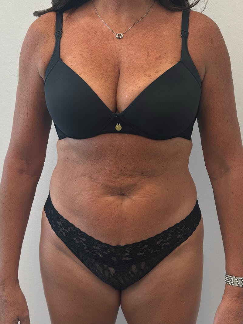 Tummy Tuck Before & After Gallery - Patient 234056 - Image 1