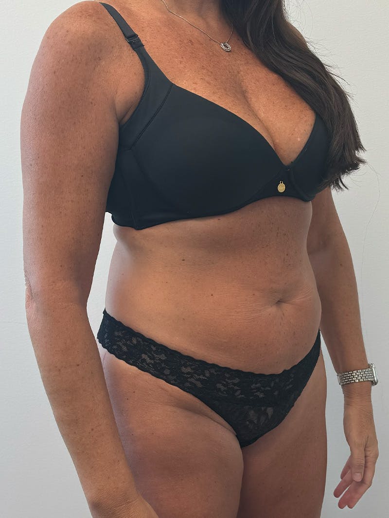 Tummy Tuck Before & After Gallery - Patient 234056 - Image 3