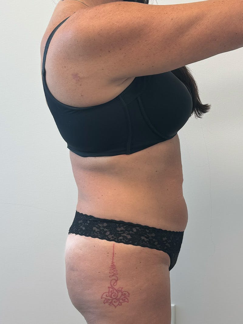 Tummy Tuck Before & After Gallery - Patient 234056 - Image 5