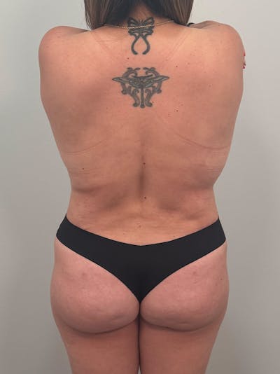 Brazilian Butt Lift Before & After Gallery - Patient 139278 - Image 1