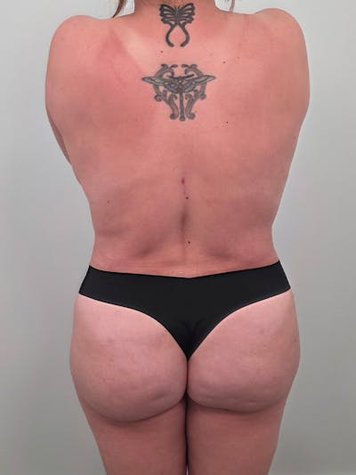 Brazilian Butt Lift Before & After Gallery - Patient 139278 - Image 2