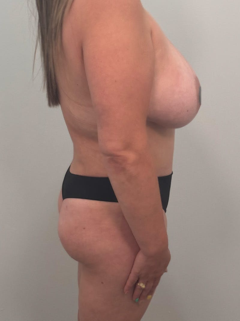 Brazilian Butt Lift Before & After Gallery - Patient 139278 - Image 3