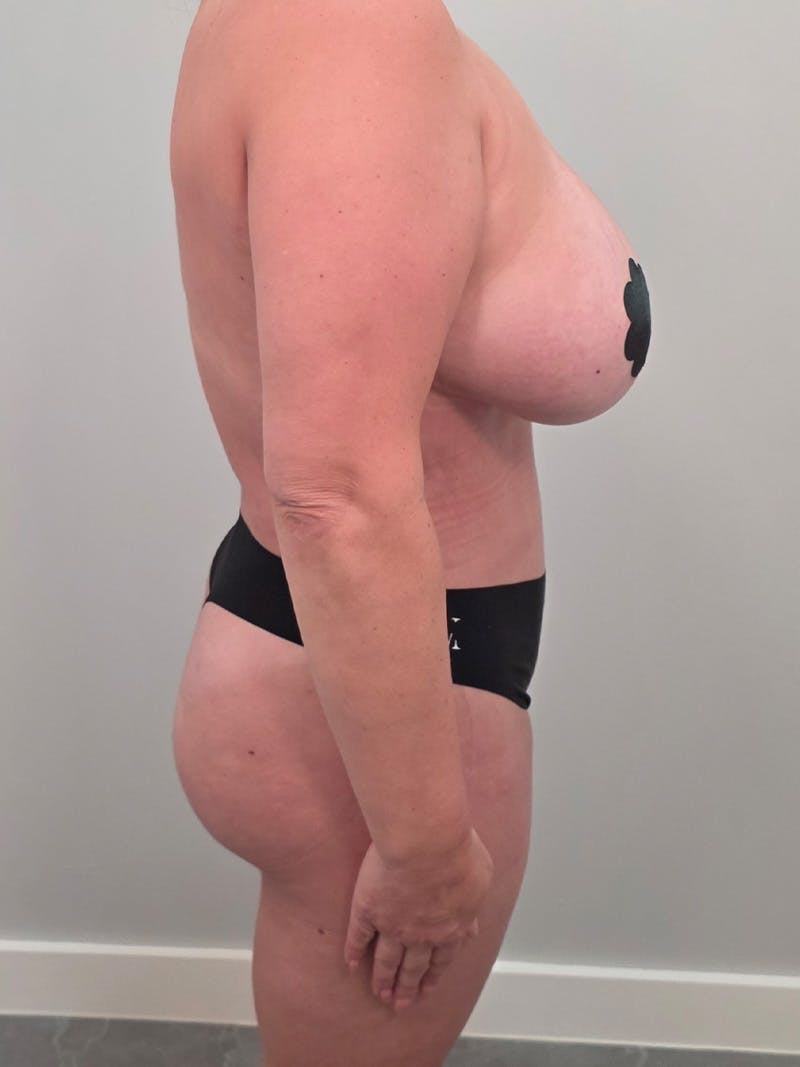 Brazilian Butt Lift Before & After Gallery - Patient 139278 - Image 4