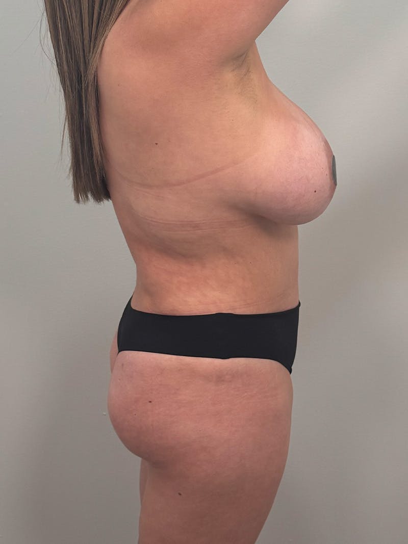 Brazilian Butt Lift Before & After Gallery - Patient 139278 - Image 5