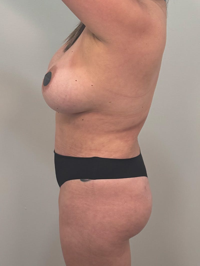 Brazilian Butt Lift Before & After Gallery - Patient 139278 - Image 9