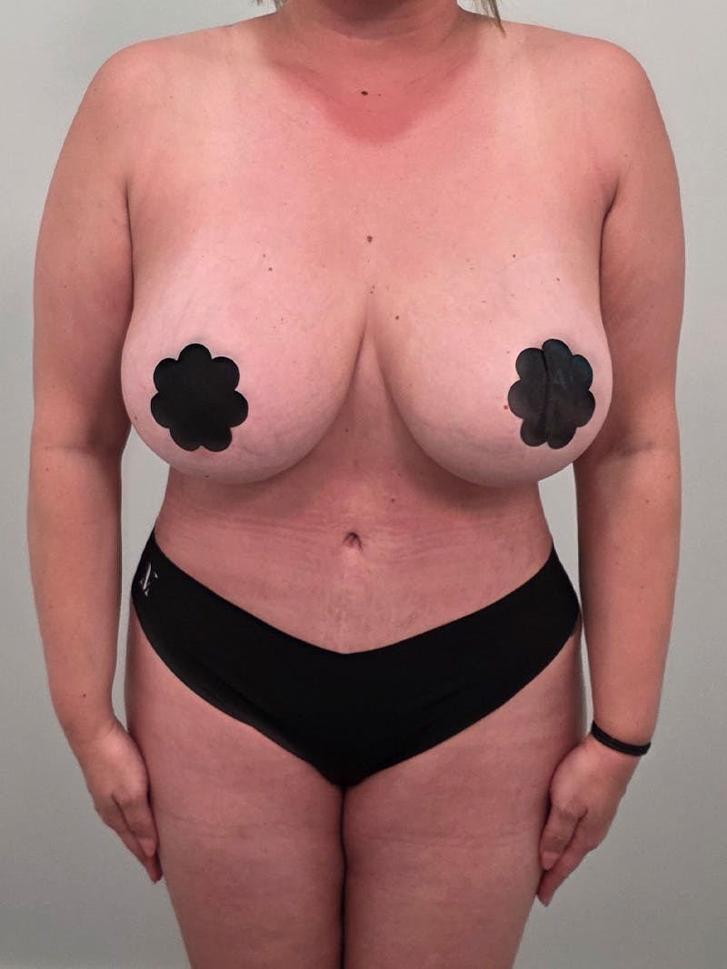 Brazilian Butt Lift Before & After Gallery - Patient 139278 - Image 12