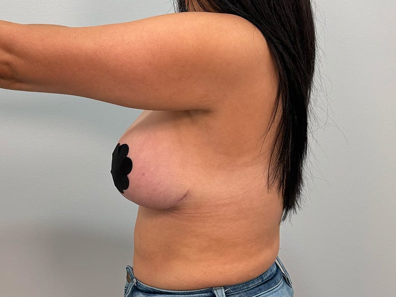 Breast Augmentation-Mastopexy Before & After Gallery - Patient 212908 - Image 14