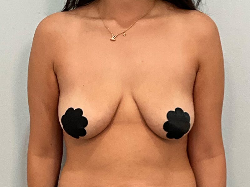 Breast Augmentation-Mastopexy Before & After Gallery - Patient 212908 - Image 1