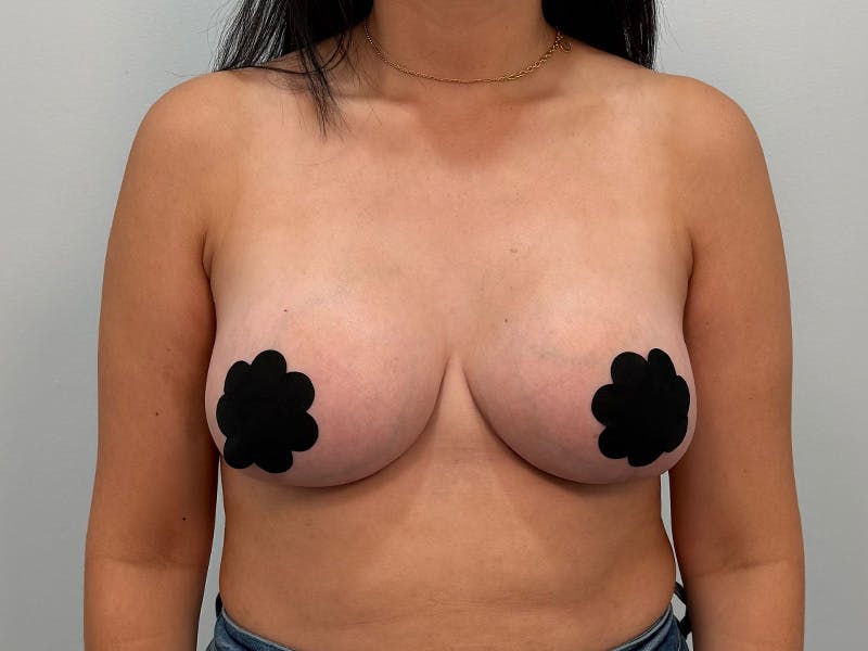 Breast Augmentation-Mastopexy Before & After Gallery - Patient 212908 - Image 2