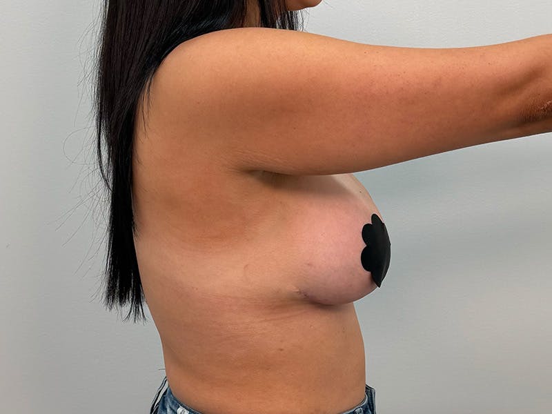 Breast Augmentation-Mastopexy Before & After Gallery - Patient 212908 - Image 8