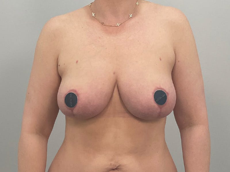 Breast Augmentation-Mastopexy Before & After Gallery - Patient 490179 - Image 2