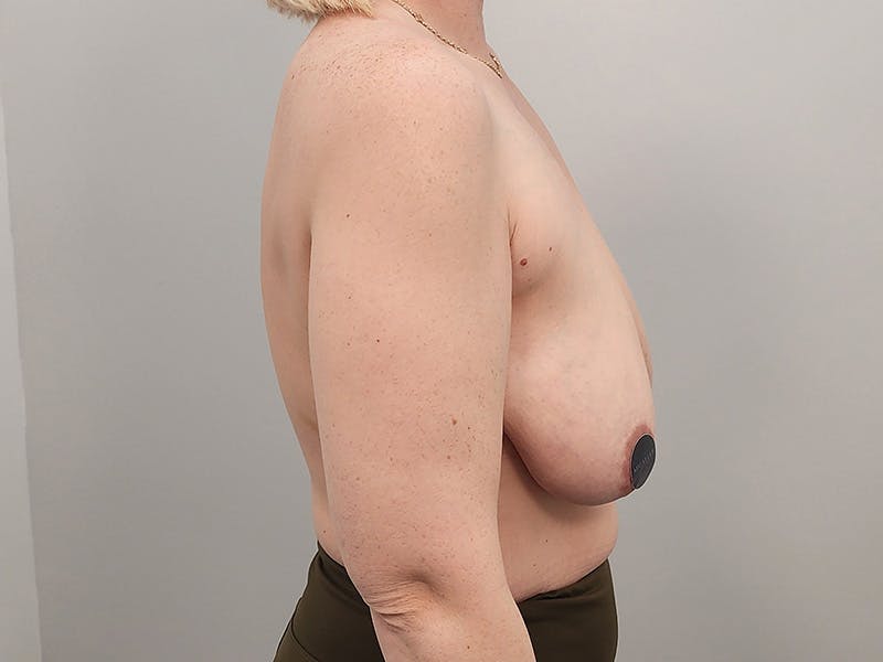 Breast Augmentation-Mastopexy Before & After Gallery - Patient 490179 - Image 5