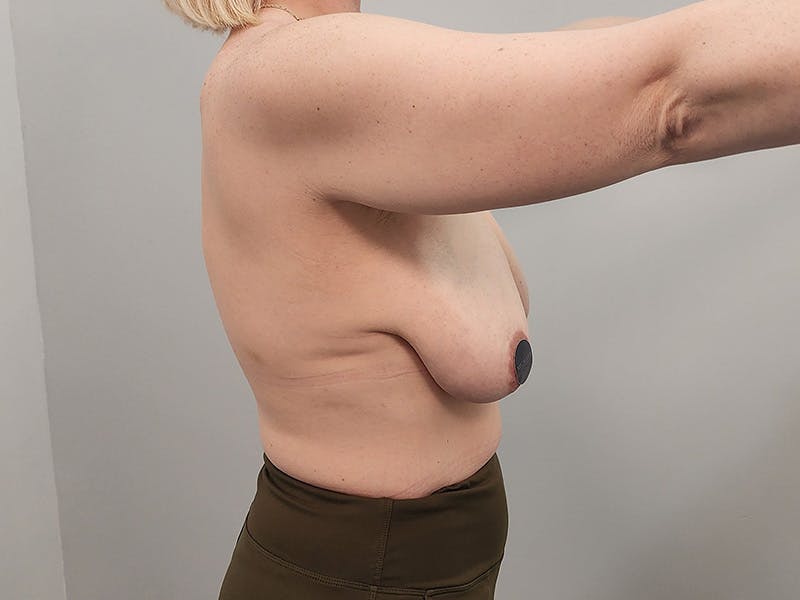 Breast Augmentation-Mastopexy Before & After Gallery - Patient 490179 - Image 7