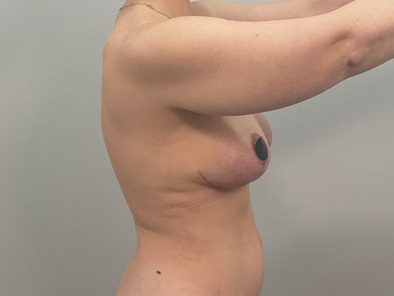Breast Augmentation-Mastopexy Before & After Gallery - Patient 490179 - Image 8