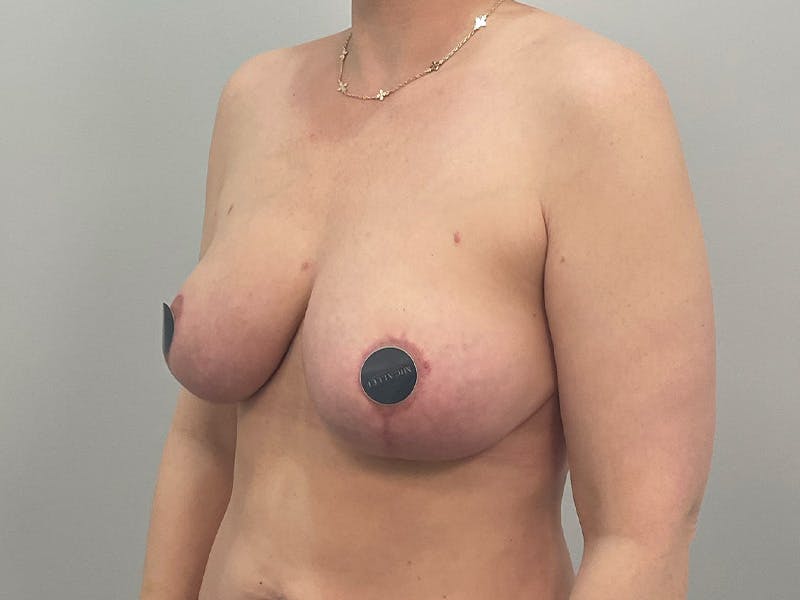 Breast Augmentation-Mastopexy Before & After Gallery - Patient 490179 - Image 10