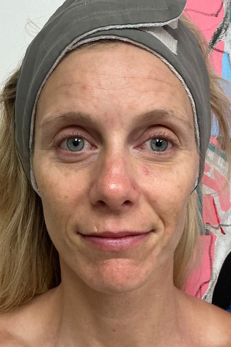 Facial Rejuvenation Before & After Gallery - Patient 367493 - Image 1