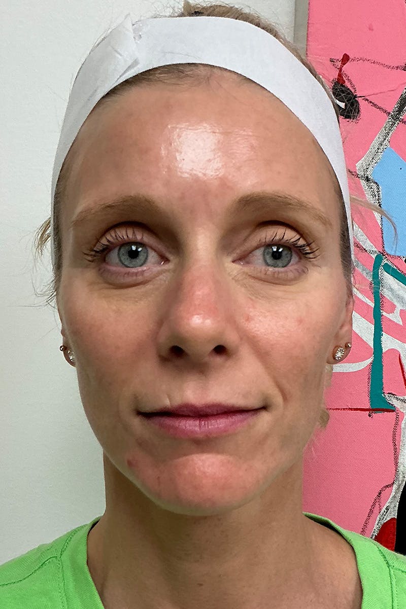 Facial Rejuvenation Before & After Gallery - Patient 367493 - Image 2