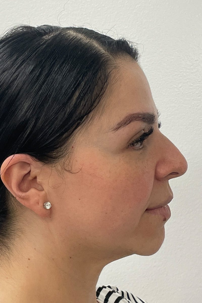 Facial Rejuvenation Before & After Gallery - Patient 135847 - Image 3