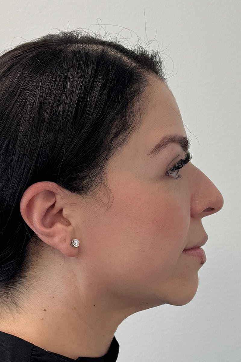 Facial Rejuvenation Before & After Gallery - Patient 135847 - Image 4