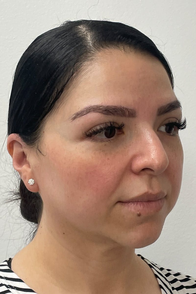 Facial Rejuvenation Before & After Gallery - Patient 135847 - Image 1