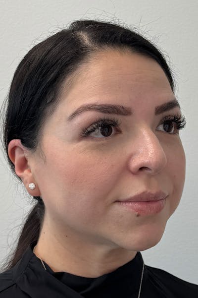 Facial Rejuvenation Before & After Gallery - Patient 135847 - Image 2