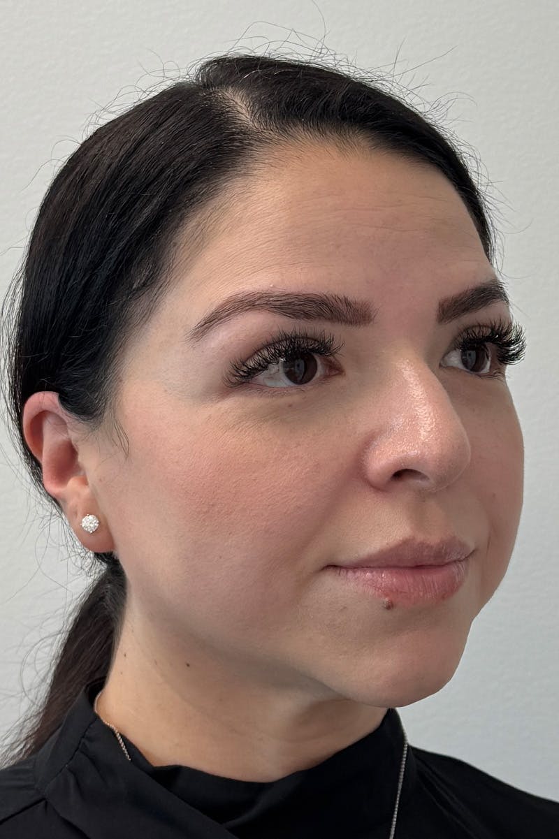 Facial Rejuvenation Before & After Gallery - Patient 135847 - Image 2