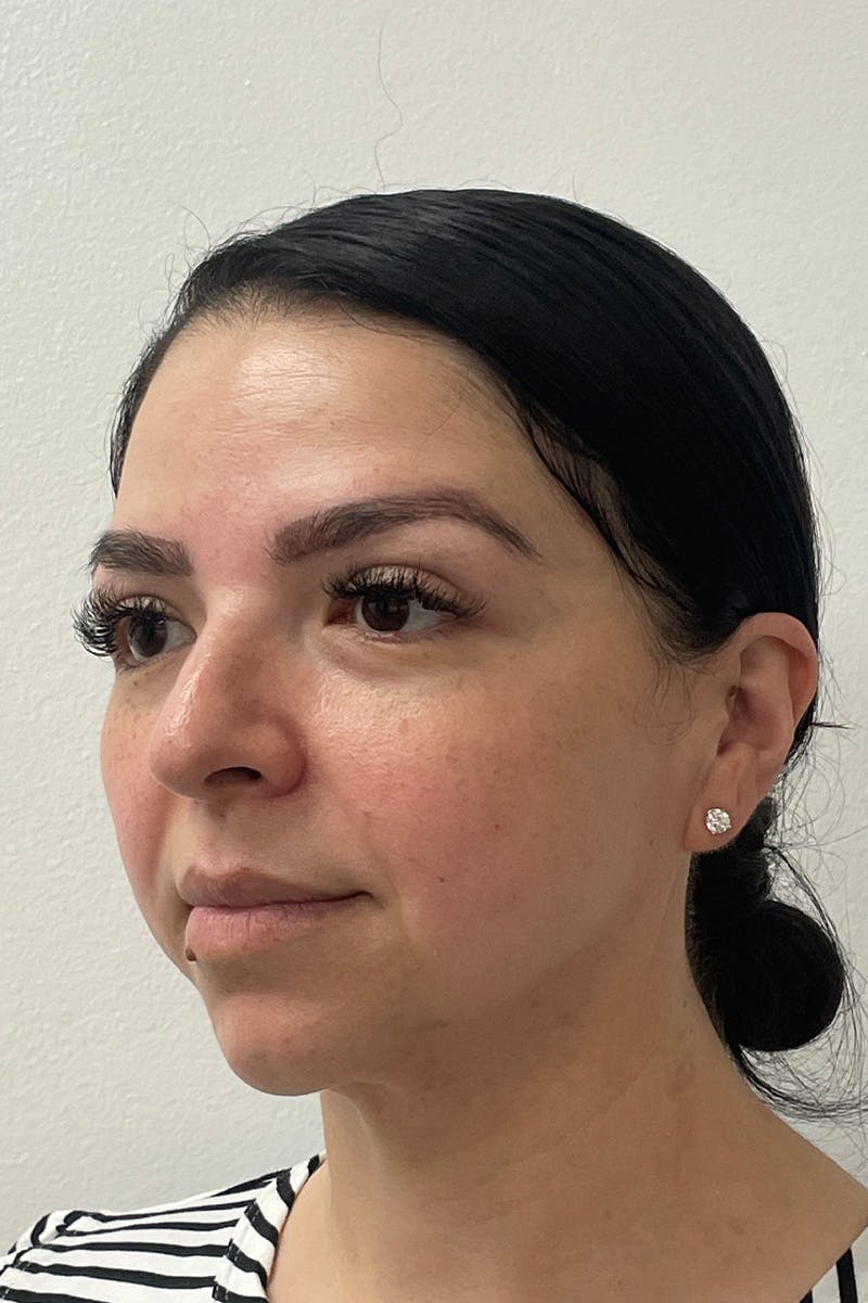 Facial Rejuvenation Before & After Gallery - Patient 135847 - Image 5