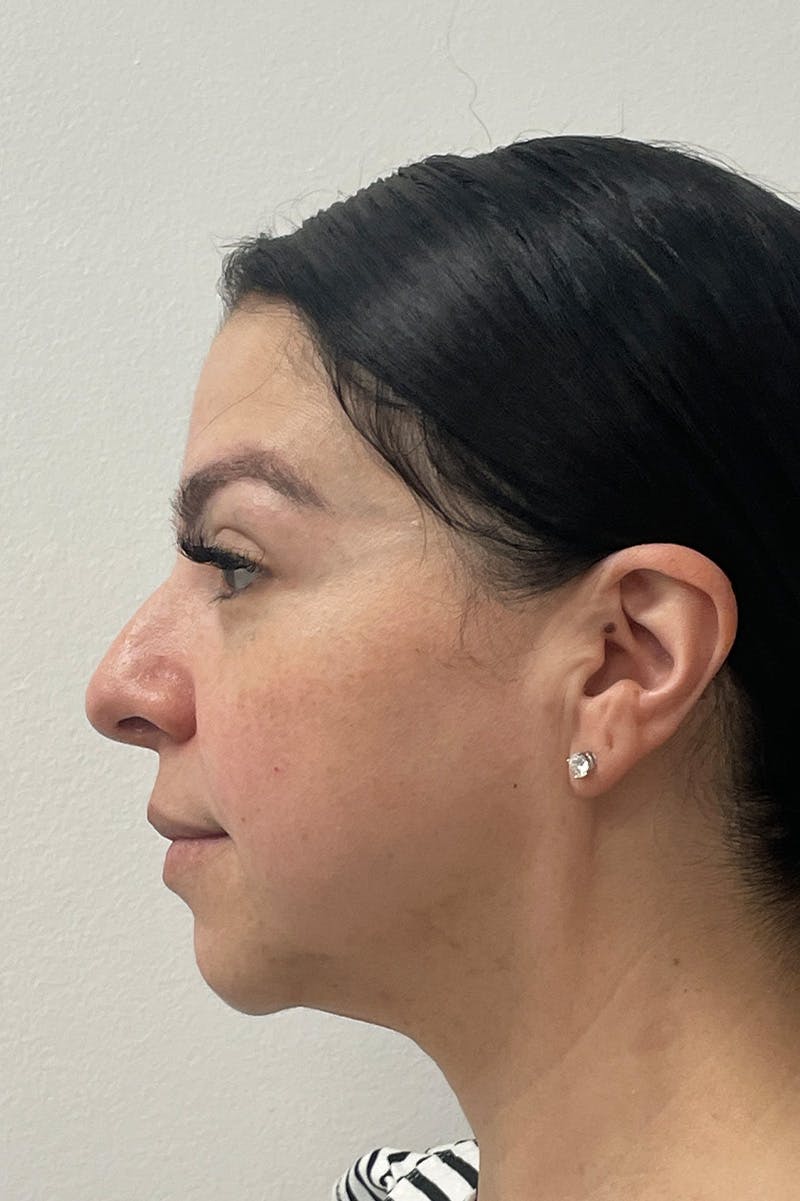 Facial Rejuvenation Before & After Gallery - Patient 135847 - Image 7