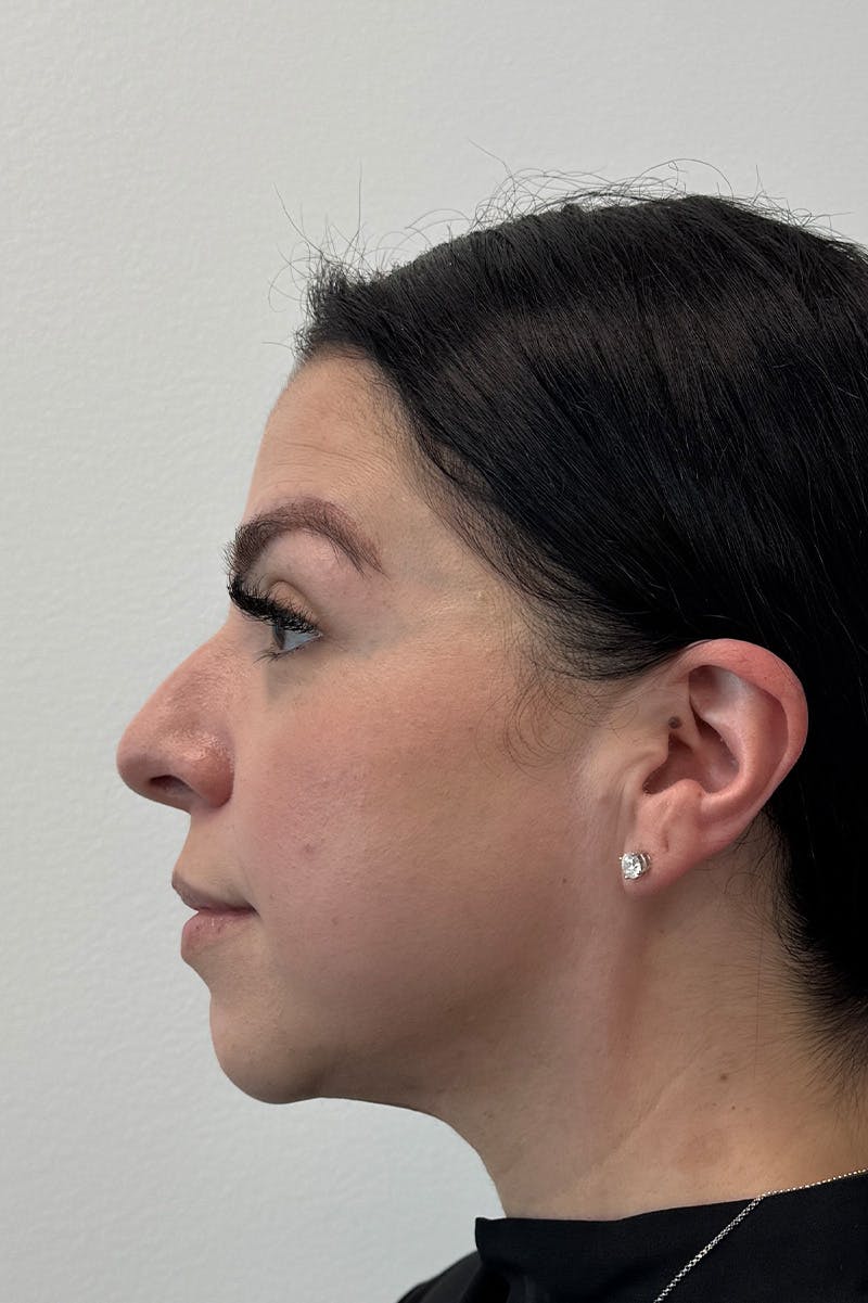 Facial Rejuvenation Before & After Gallery - Patient 135847 - Image 8