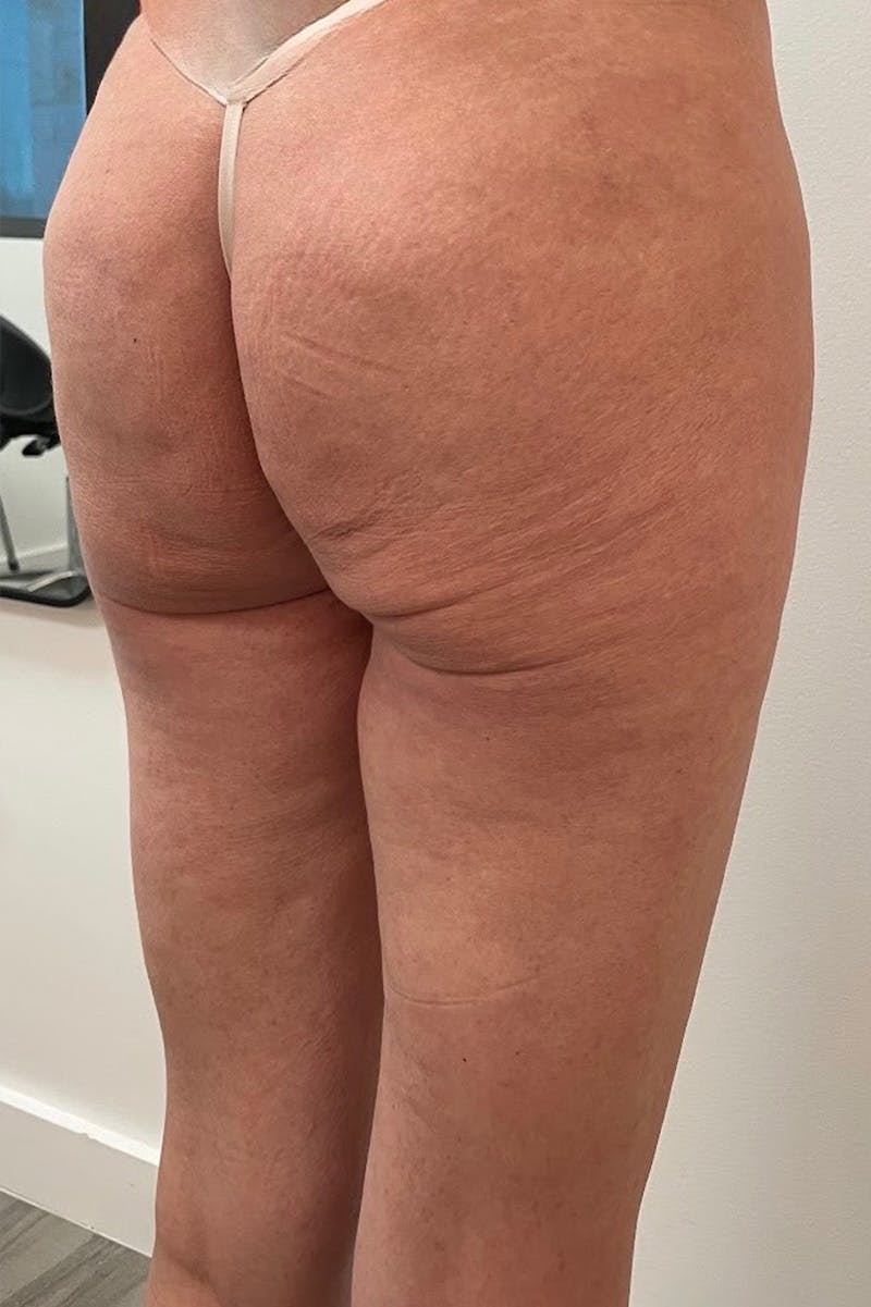 Biostimulator Before & After Gallery - Patient 940688 - Image 1